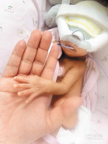 臺(tái)1350克巴掌嬰兒心導(dǎo)管手術(shù)成功創(chuàng)亞洲紀(jì)錄(圖)