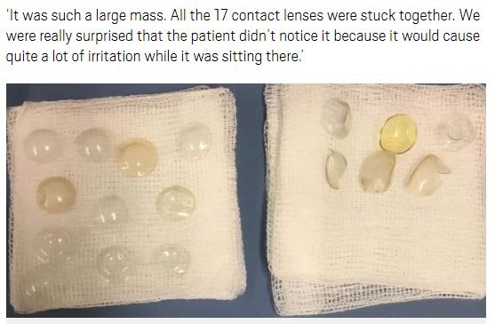 白內(nèi)障手術(shù)夾出27片隱形眼鏡 白內(nèi)障手術(shù)夾出27片隱形眼鏡