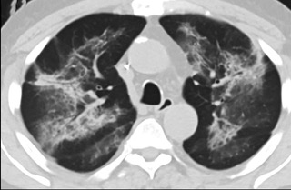 6�����S��CTƽ�߈D���@ʾë����Ӱ׃?y��u)�?sh��)׃���p�ȽY(ji��)��(g��u)Ť����(ͬһ����CTӰ��)