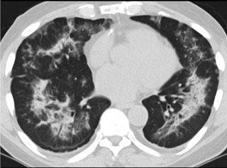 6�����S��CTƽ�߈D���@ʾë����Ӱ׃?y��u)�?sh��)׃���p�ȽY(ji��)��(g��u)Ť����(ͬһ����CTӰ��)